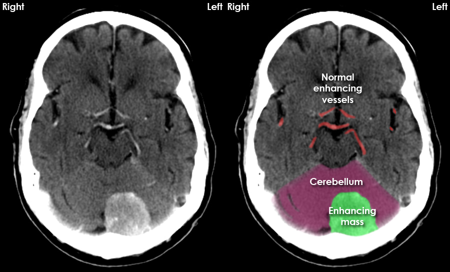 CT brain image gallery - Meningioma