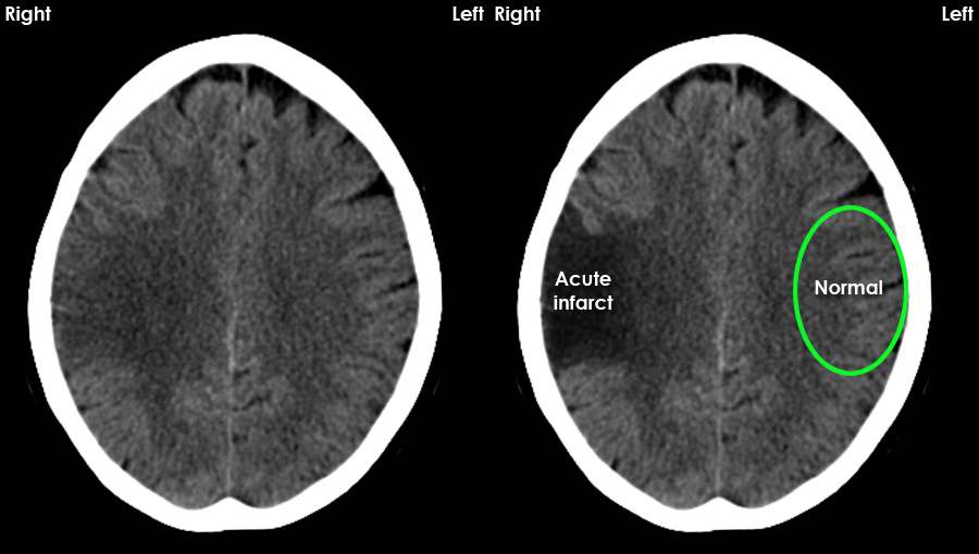 Acute CT Brain Acute Ischaemia