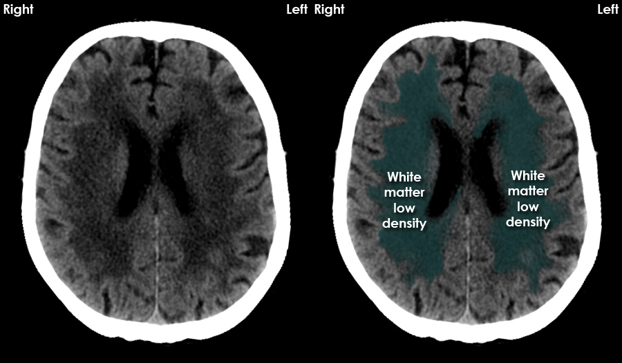 acute-ct-brain-chronic-ischaemia