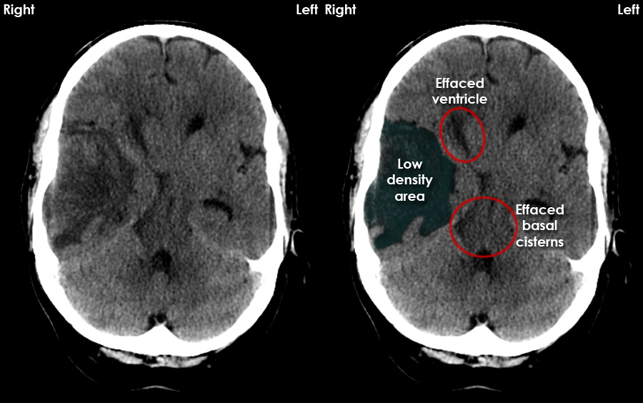 Acute Ct Brain Intracranial Masses