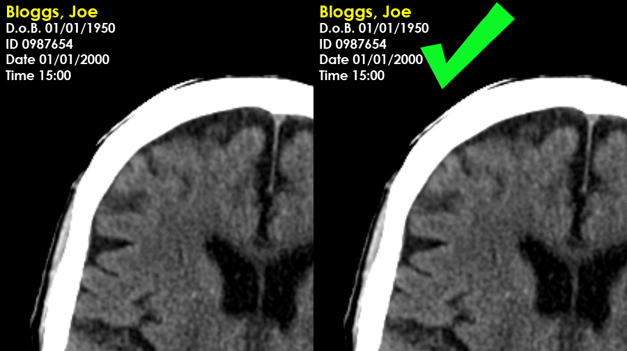 Acute CT Brain - Patient And Image Information