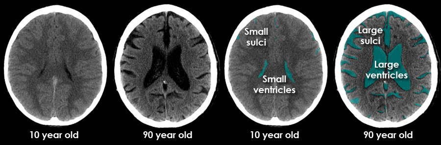 Acute CT Brain - Brain Volume