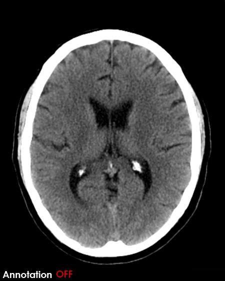 CT brain image gallery - SAH