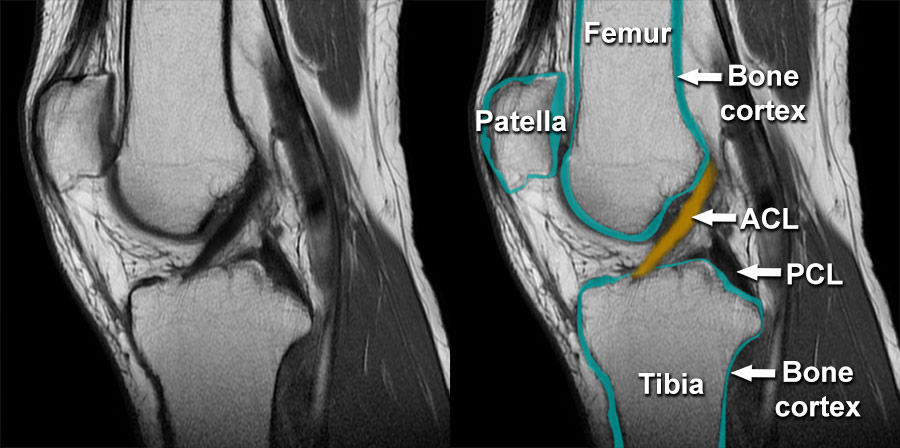 Anterior Cruciate Ligament Mri