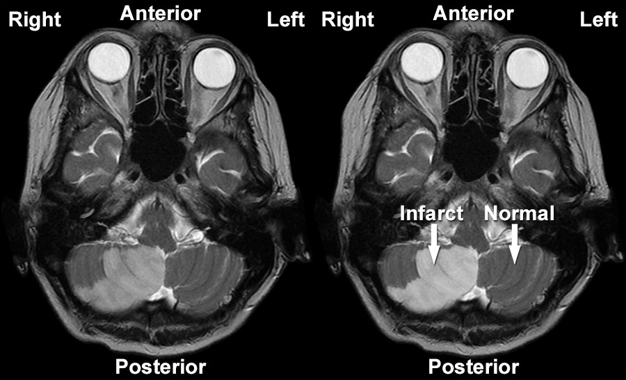 stroke-brain-mri