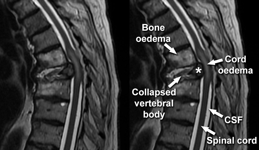 normal thoracic spine mri