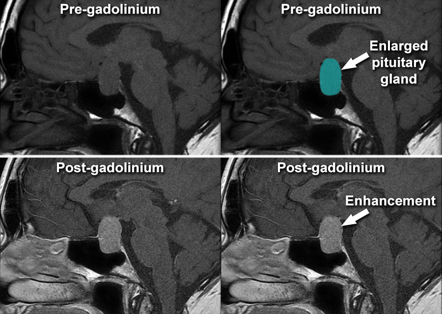 Pituitary Tumor Mri