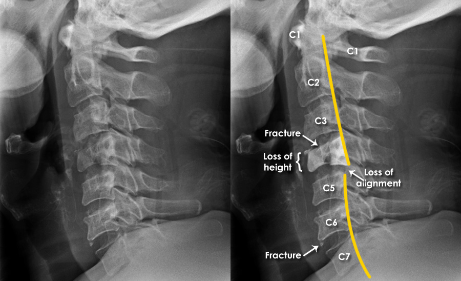 cpt code for cervical spine x ray