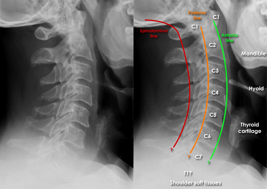 x ray for cervical spine