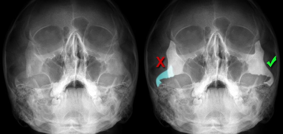 Zygomatic Arch Anatomy Britannicacom