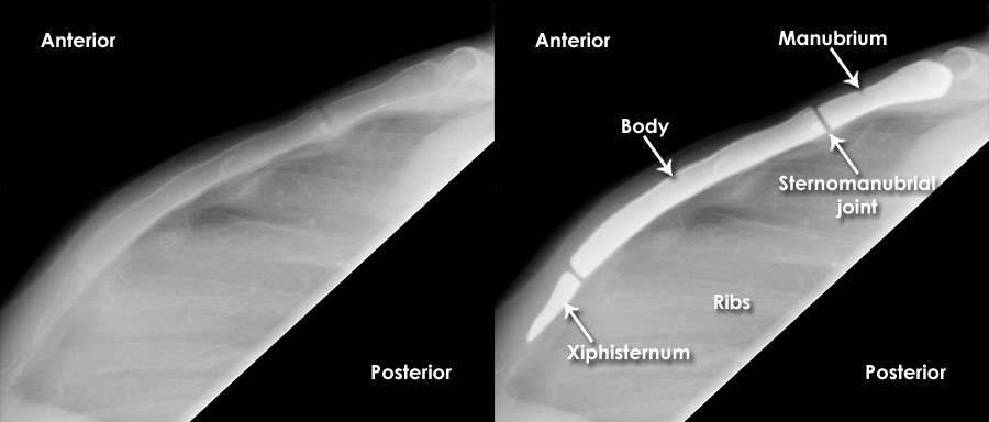 Trauma X Ray Axial Skeleton Gallery 2 Sternum Fractures