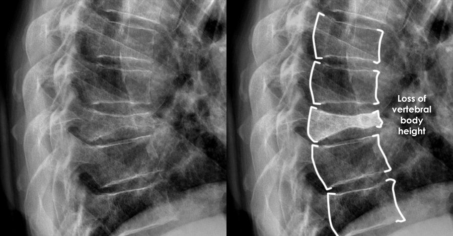 Trauma X ray Axial skeleton gallery 2 Thoracic spine Fractures