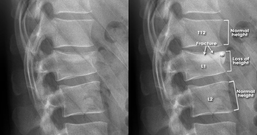 Trauma X ray Axial skeleton Thoracolumbar spine Abnormal