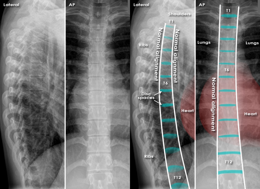 X-ray of the dorsolumbar spine (Ap and Lat)