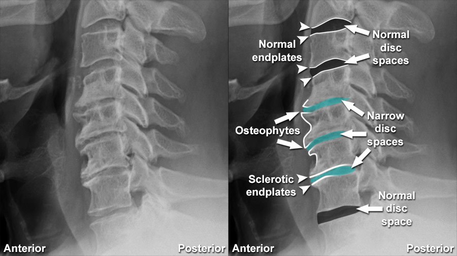 infection of the cervical spine x ray