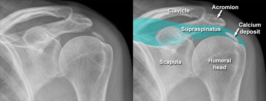 Radiological identification and analysis of soft tissue musculoskeletal  calcifications, Insights into Imaging