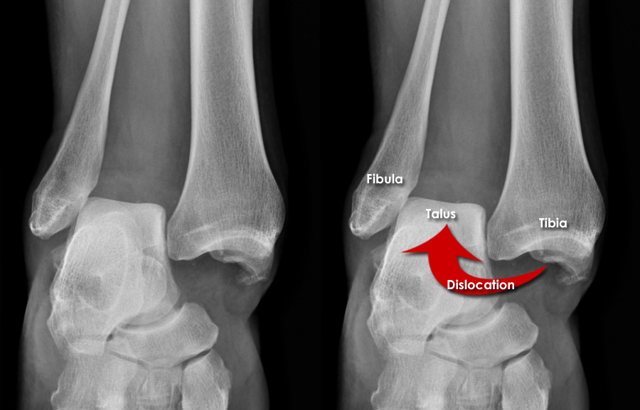 X Ray Ankle Dislocation Medworldonline