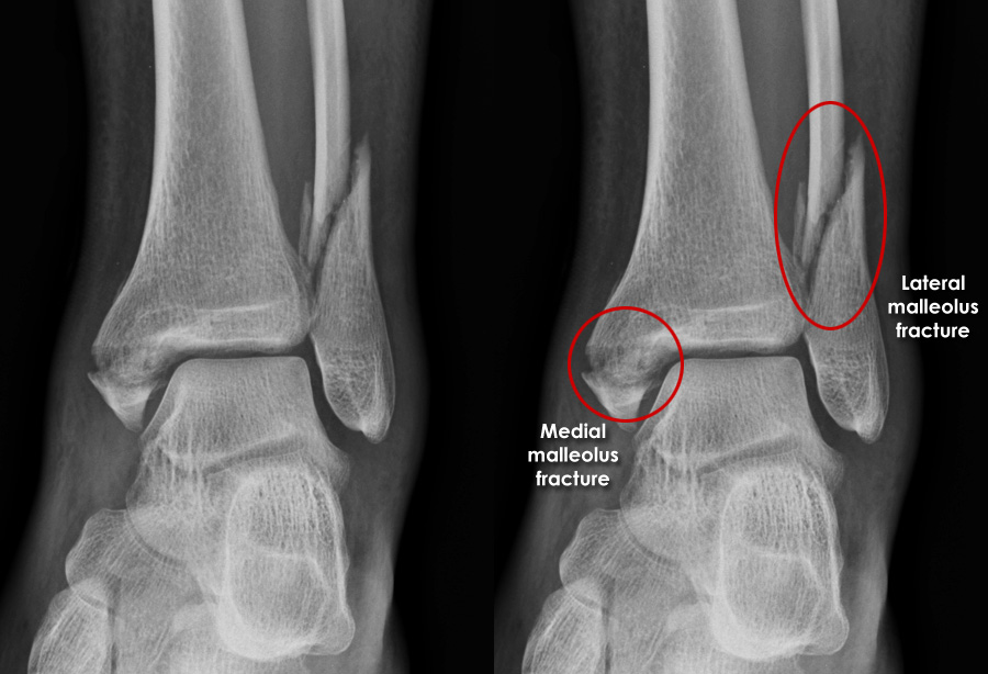 Trauma X ray Lower limb gallery 2 Ankle Trimalleolar fracture