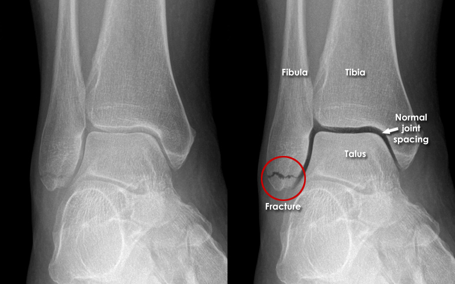 Trauma X-ray - Lower Limb Gallery 2 - Ankle - Malleolar Fractures