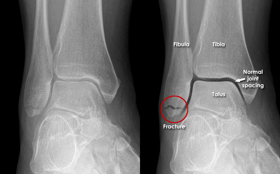 medial malleolus fracture