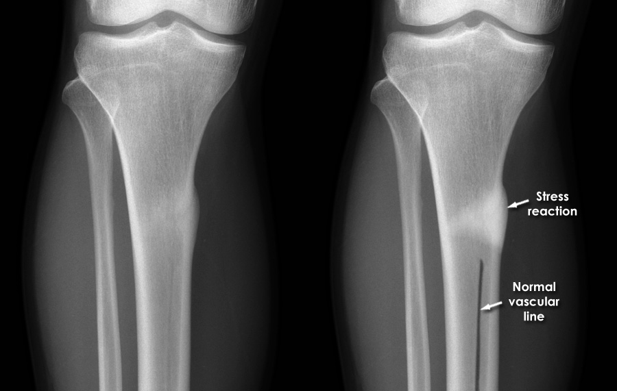 open tib fib fracture x ray