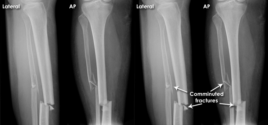 Trauma X ray Lower limb Tibia and fibula