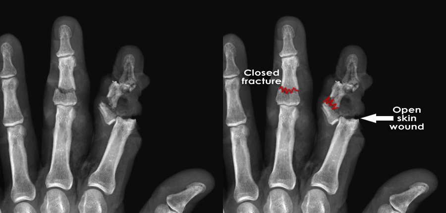 Introduction to Trauma X ray Fracture complications