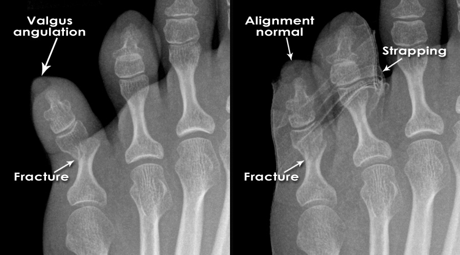 open fracture x ray