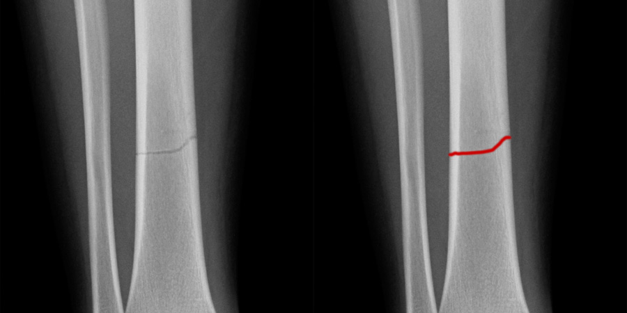 Introduction to Trauma X ray Fracture description