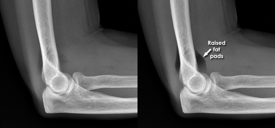 Elbow Radial Head Fracture