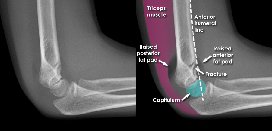 icd 10 code closed supracondylar fracture elbow