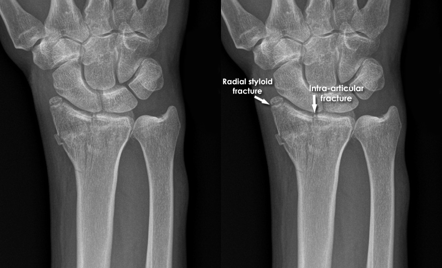 Trauma X ray Upper limb gallery 2 Distal radius fracture