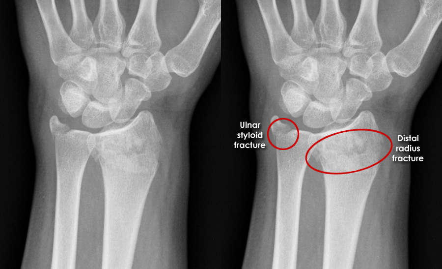 Trauma X ray Upper limb gallery 2 Colles fracture