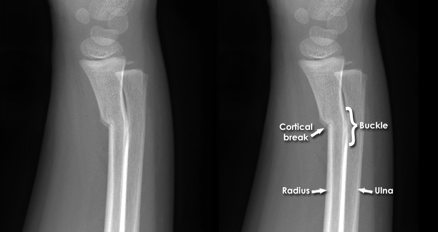 greenstick fracture orthobullets
