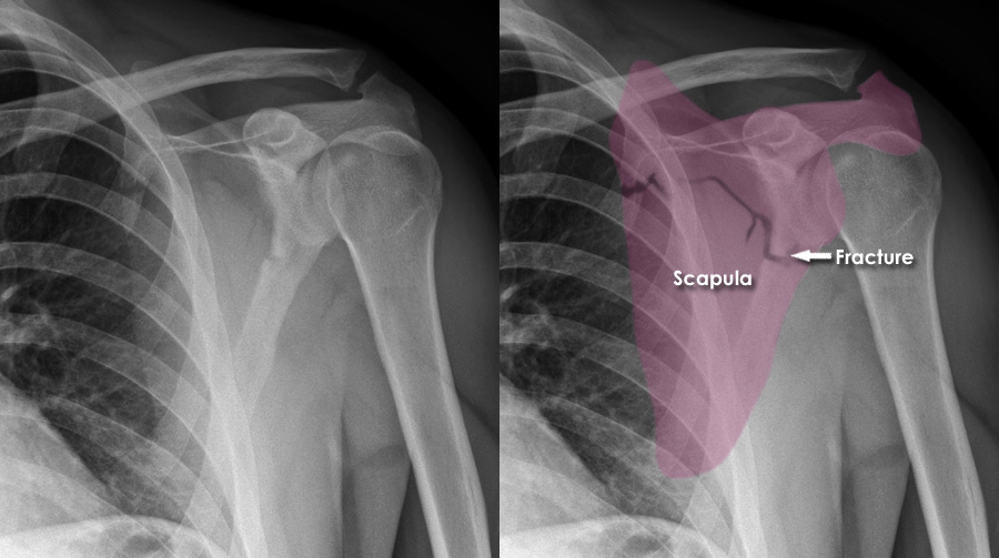 Trauma Xray Upper limb gallery 1 Scapula fractures