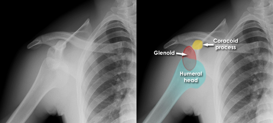 Anterior Shoulder Dislocation