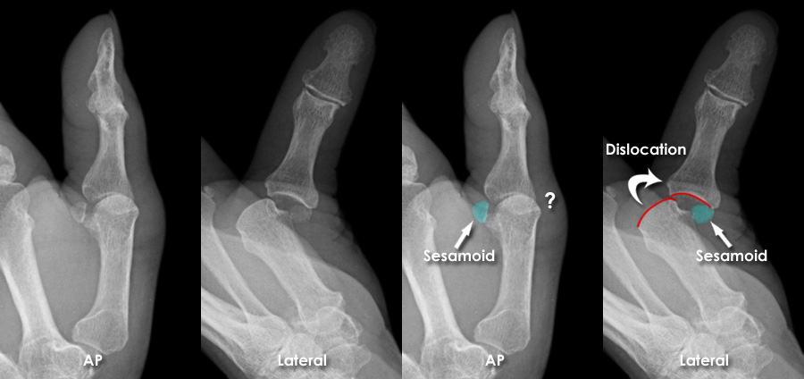 Trauma X-ray - Upper Limb Gallery 2 - Hand - Thumb Dislocation