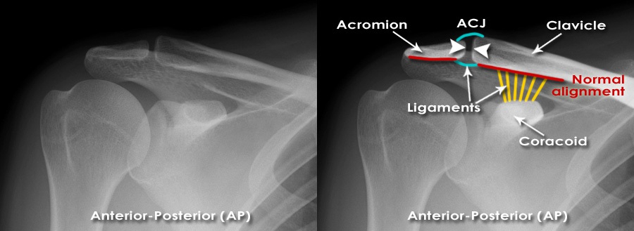 coracoacromial ligament tear