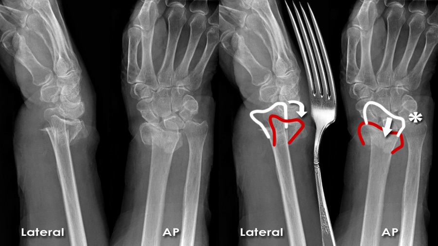 distal radioulnar joint x ray