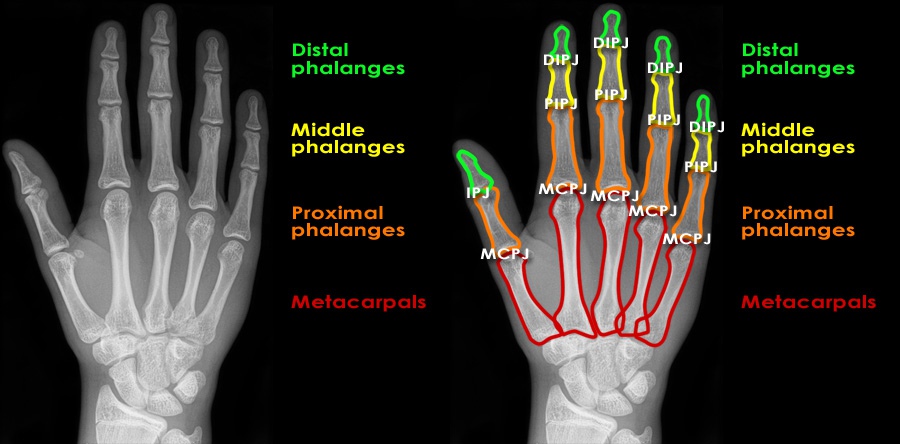 Broken Index Finger X Ray